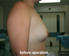 plastic-surgery-breast-augmentation